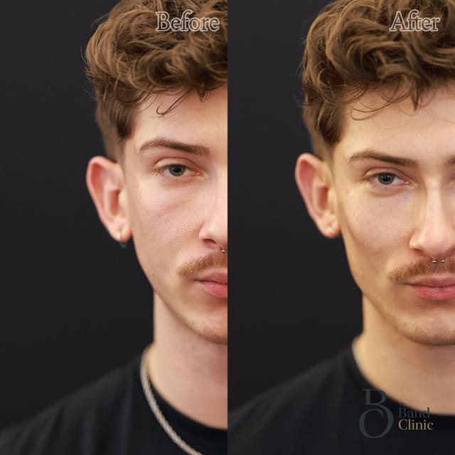 Unretouched before and after result, the drBand Clinic