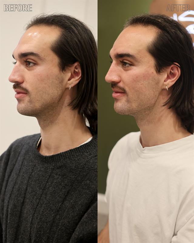 Unretouched before and after result, the drBand Clinic