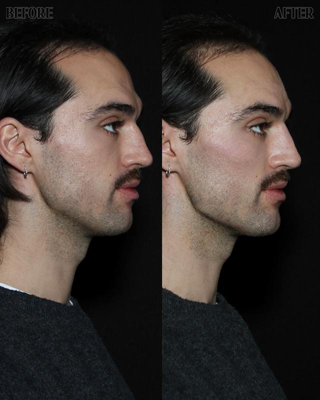 Unretouched before and after result, the drBand Clinic