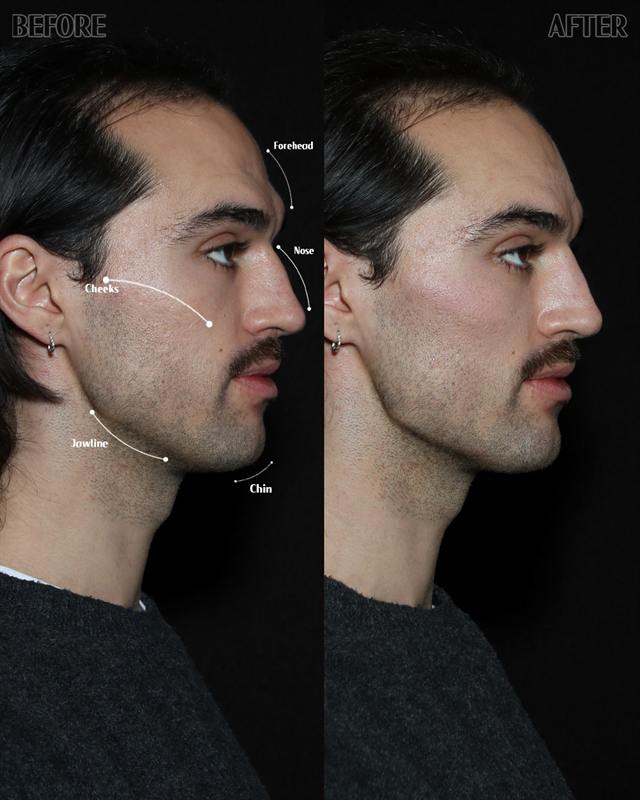 Unretouched before and after result, the drBand Clinic