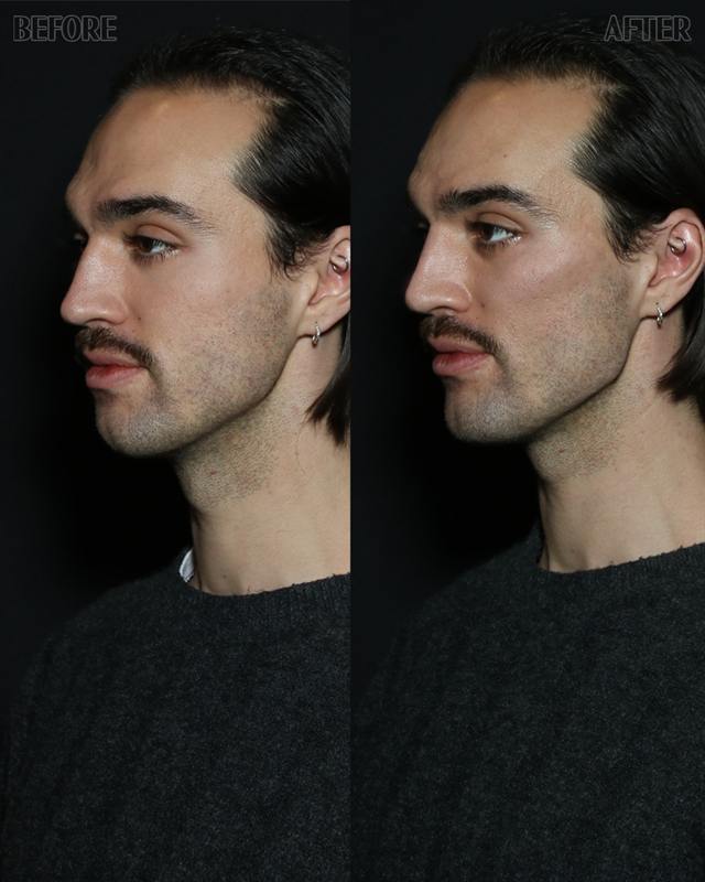 Unretouched before and after result, the drBand Clinic