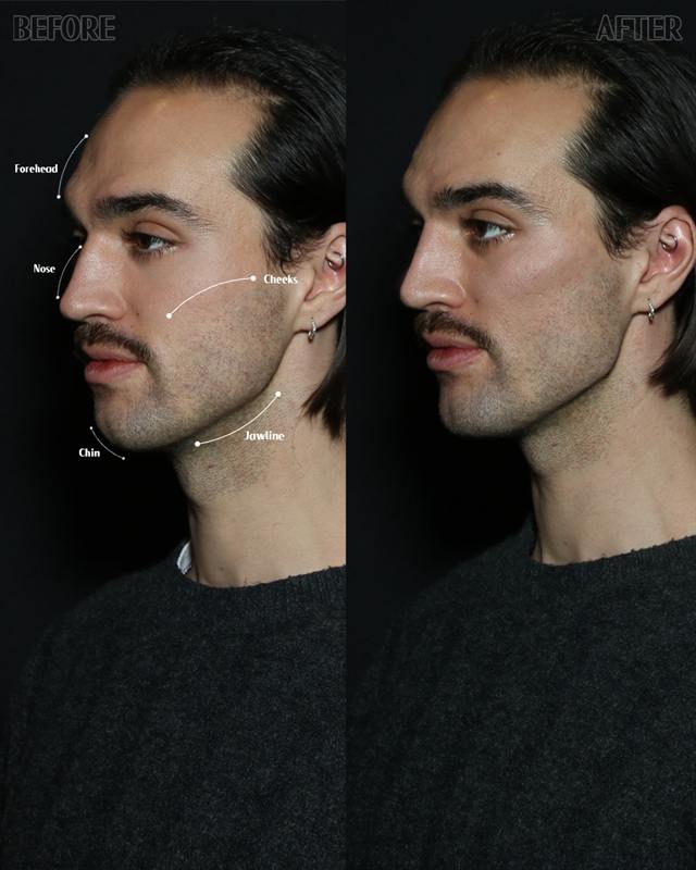 Unretouched before and after result, the drBand Clinic