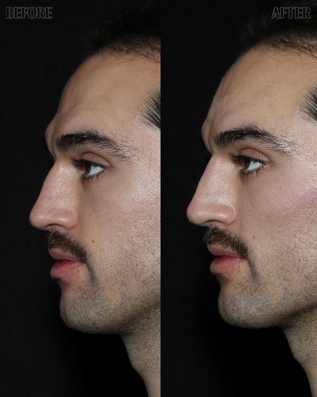 Unretouched before and after result, the drBand Clinic