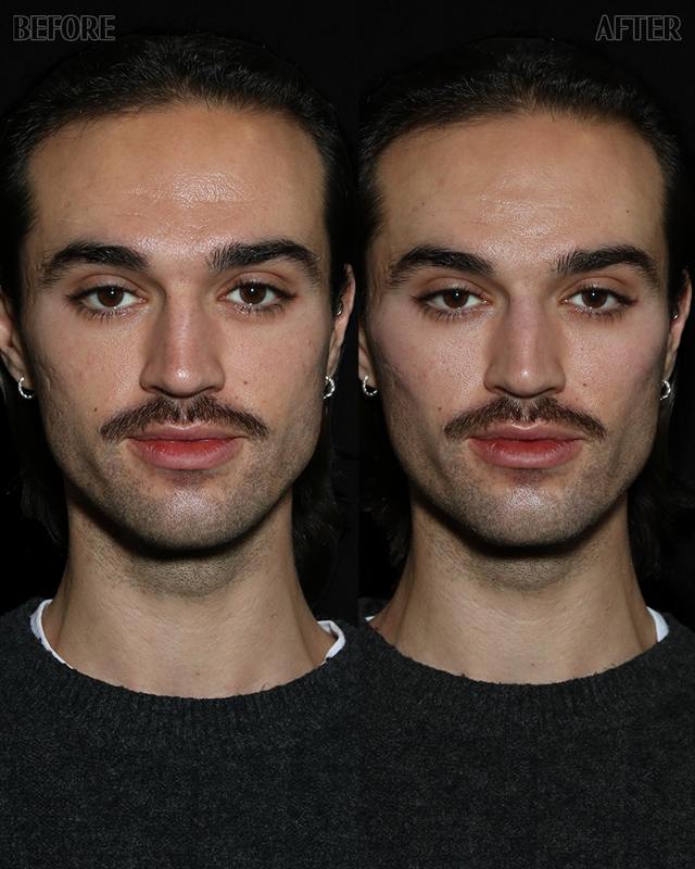Unretouched before and after result, the drBand Clinic