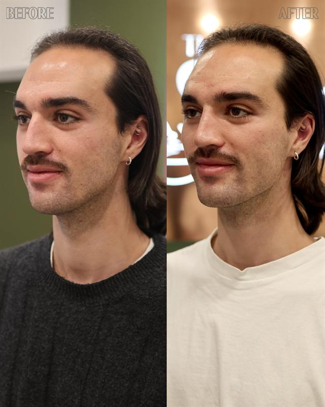 Unretouched before and after result, the drBand Clinic