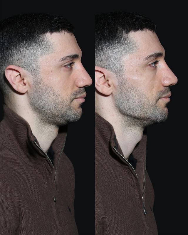 Unretouched before and after result, the drBand Clinic