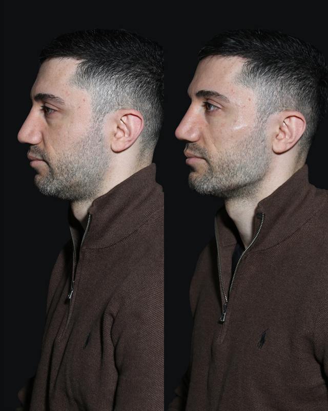 Unretouched before and after result, the drBand Clinic