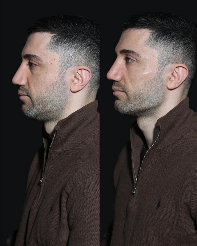 Unretouched before and after result, the drBand Clinic