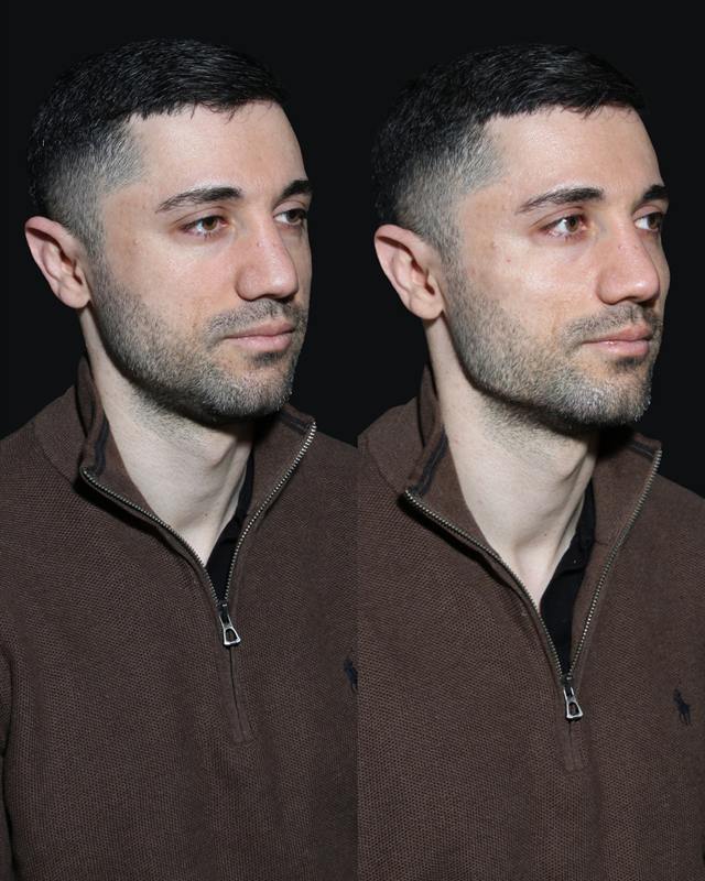 Unretouched before and after result, the drBand Clinic