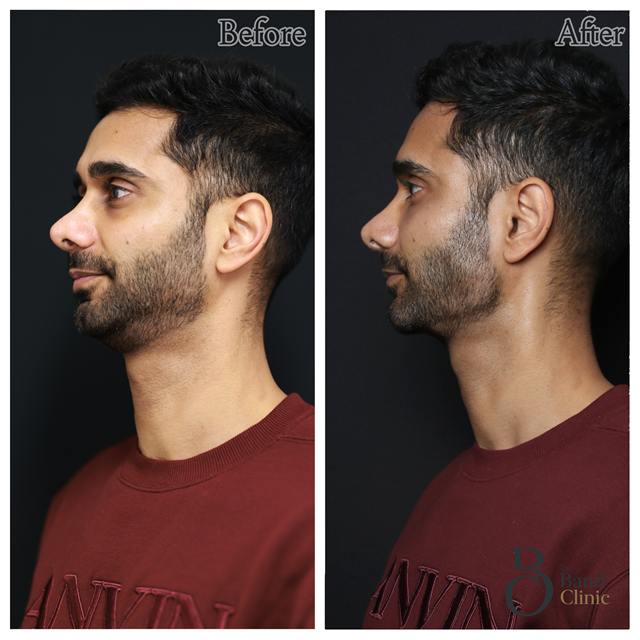 Unretouched before and after result, the drBand Clinic