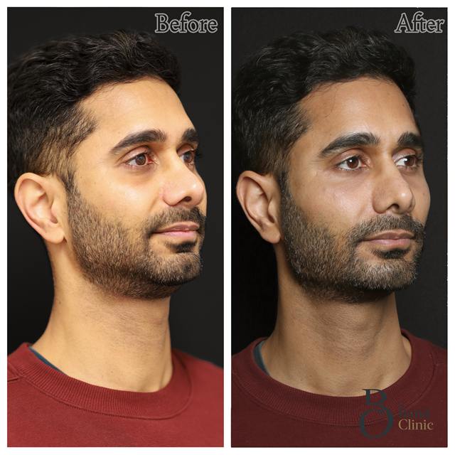 Unretouched before and after result, the drBand Clinic