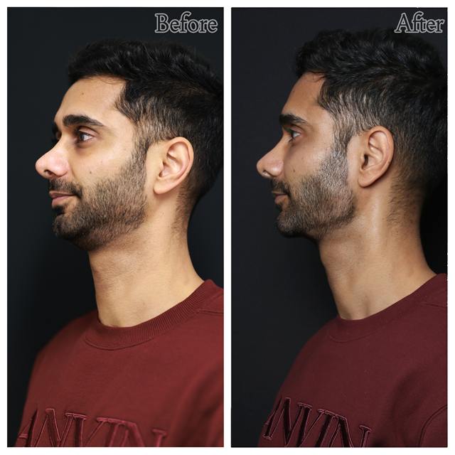 Unretouched before and after result, the drBand Clinic