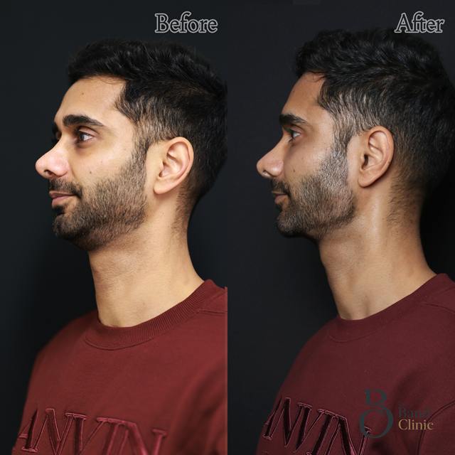 Unretouched before and after result, the drBand Clinic