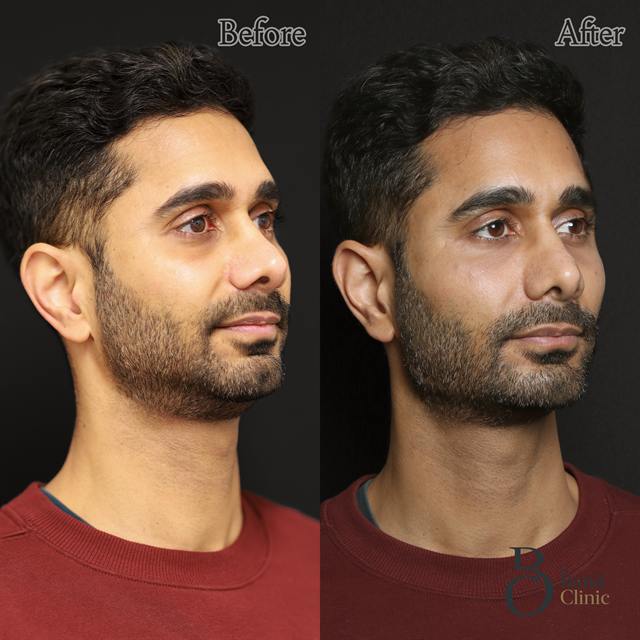 Unretouched before and after result, the drBand Clinic