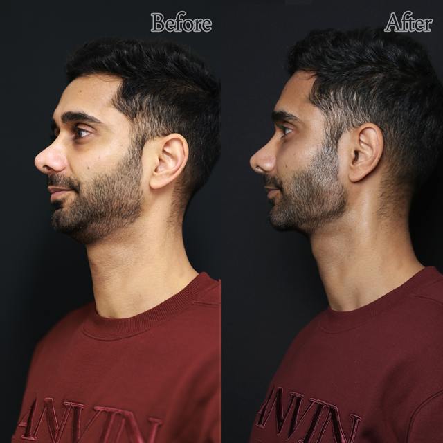 Unretouched before and after result, the drBand Clinic