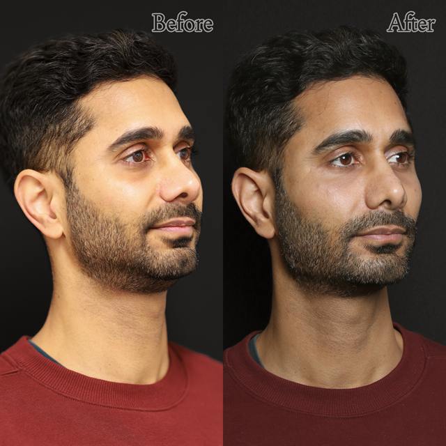 Unretouched before and after result, the drBand Clinic