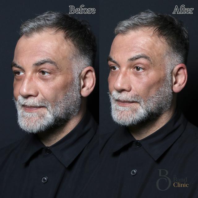 Unretouched before and after result, the drBand Clinic