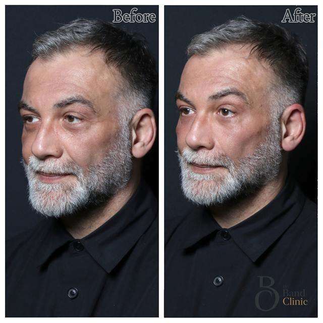 Unretouched before and after result, the drBand Clinic