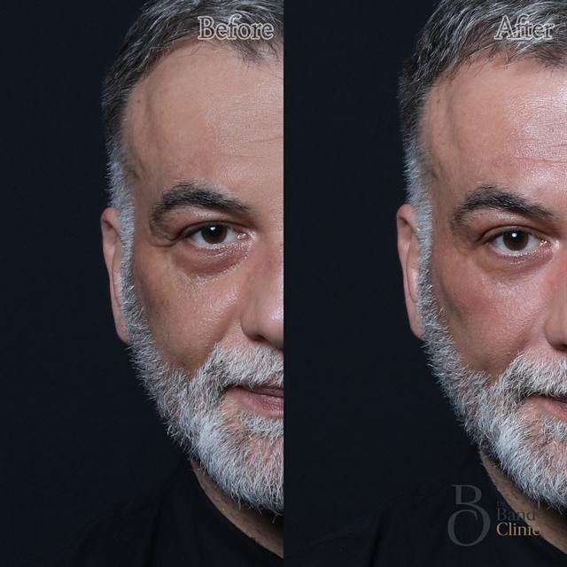 Unretouched before and after result, the drBand Clinic