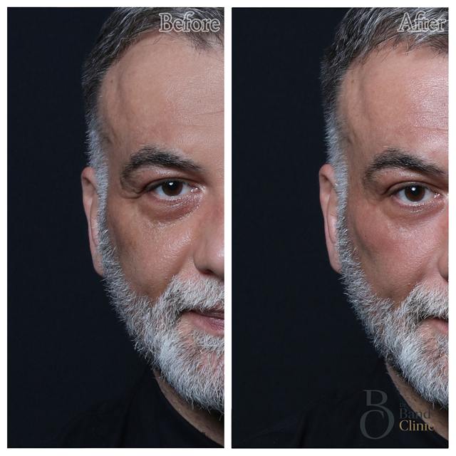 Unretouched before and after result, the drBand Clinic