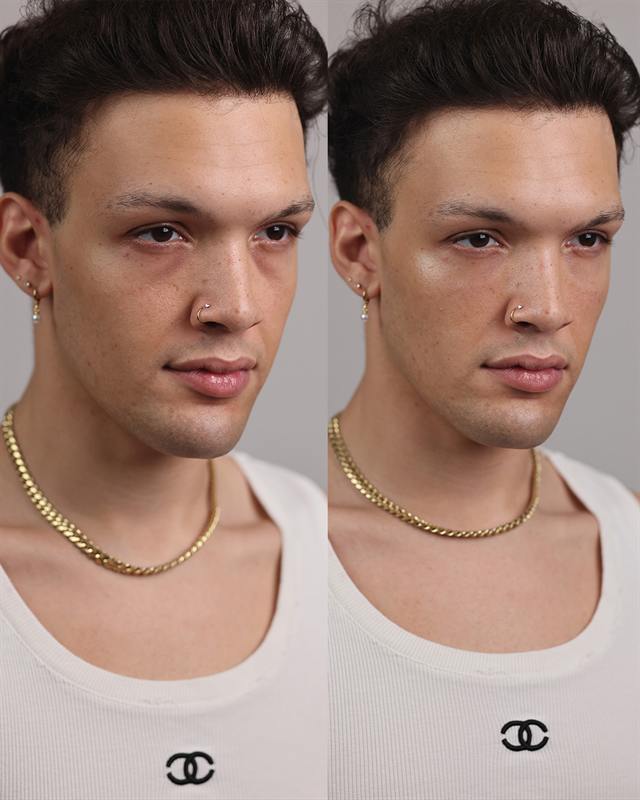 Unretouched before and after result, the drBand Clinic