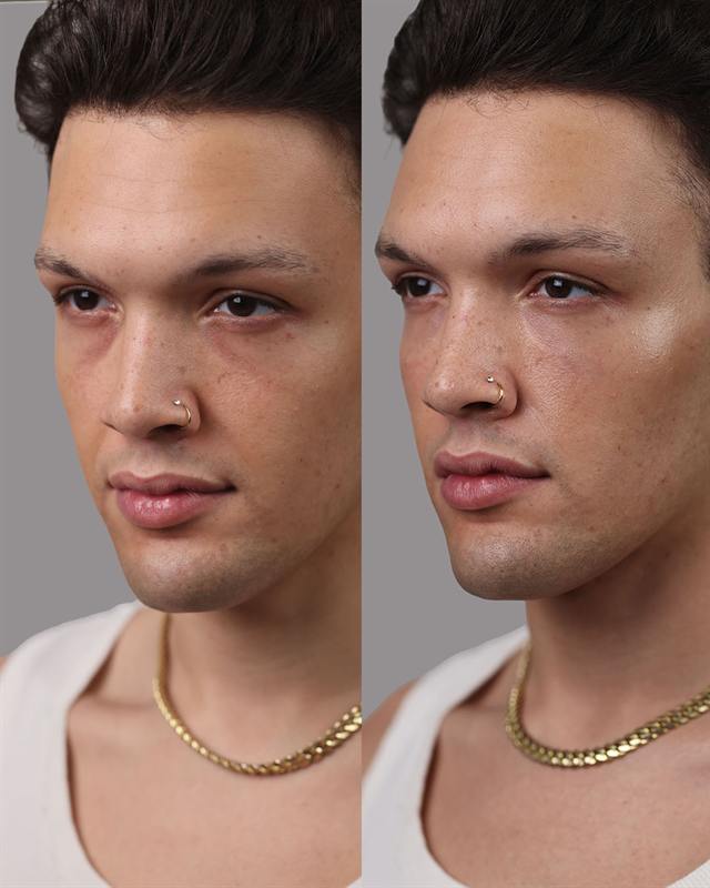 Unretouched before and after result, the drBand Clinic