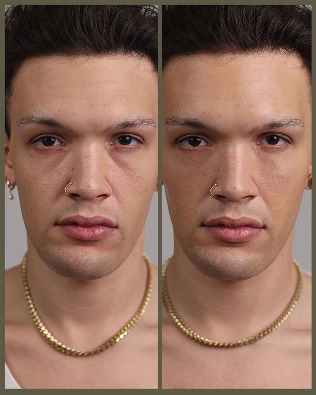 Unretouched before and after result, the drBand Clinic