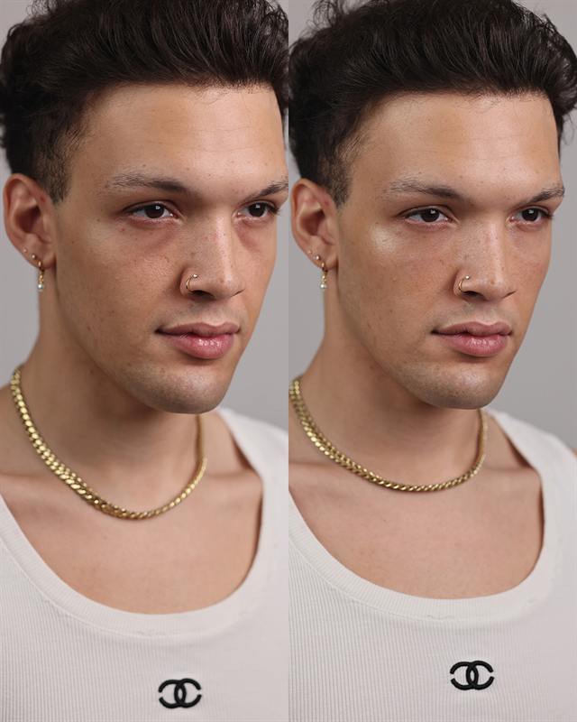Unretouched before and after result, the drBand Clinic