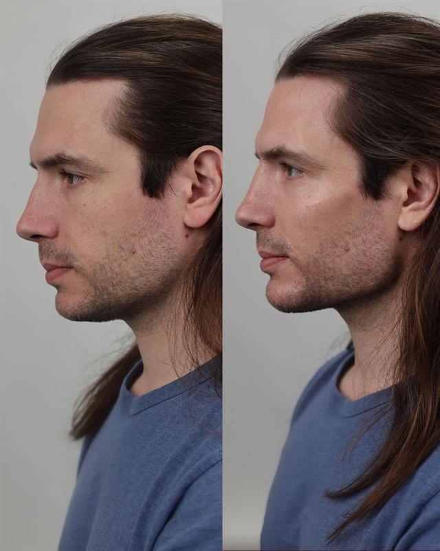 Unretouched before and after result, the drBand Clinic