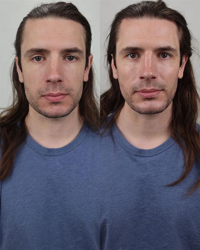 Unretouched before and after result, the drBand Clinic