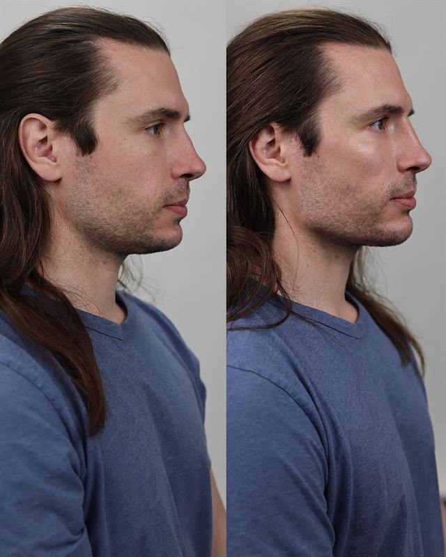 Unretouched before and after result, the drBand Clinic