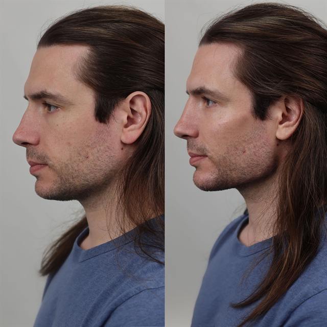 Unretouched before and after result, the drBand Clinic