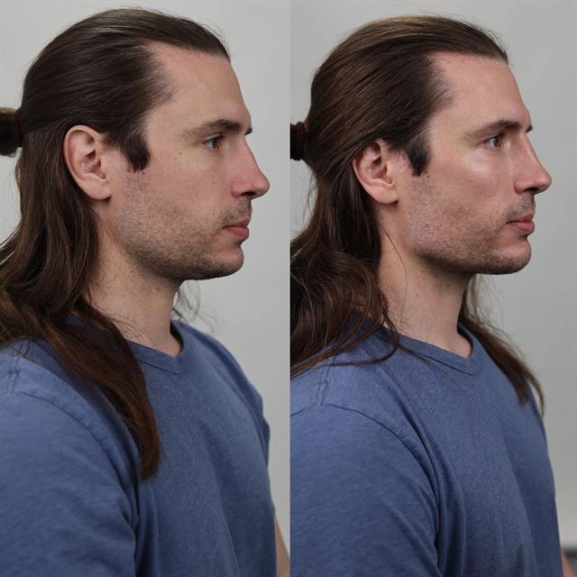 Unretouched before and after result, the drBand Clinic