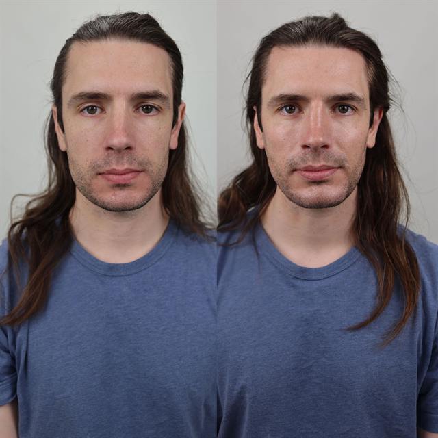 Unretouched before and after result, the drBand Clinic