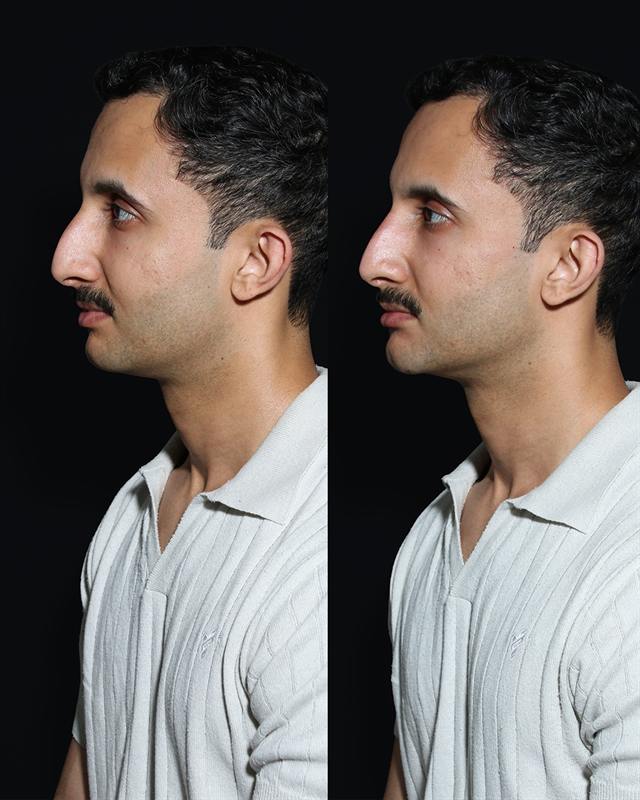 Unretouched before and after result, the drBand Clinic
