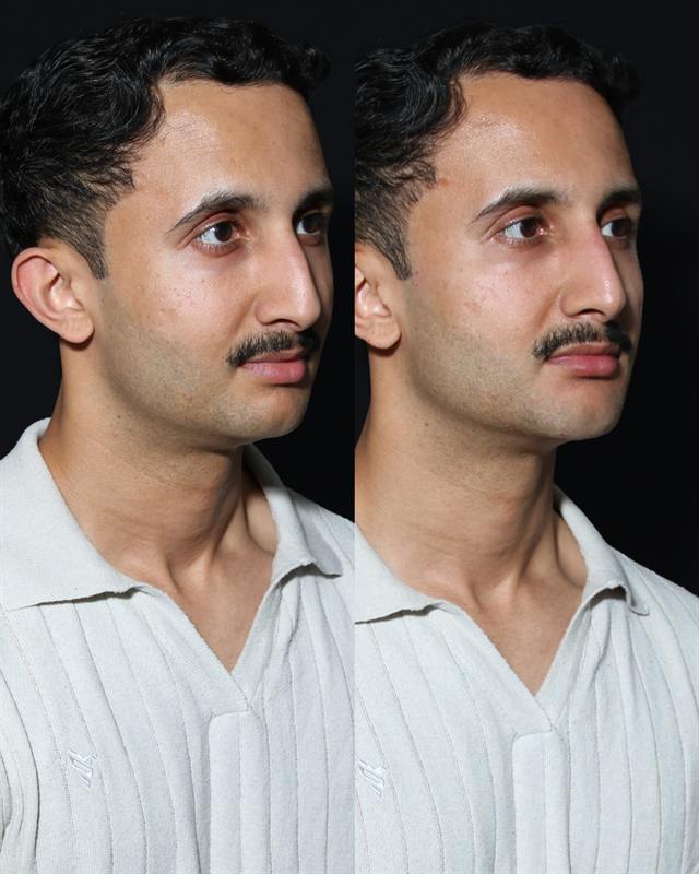 Unretouched before and after result, the drBand Clinic