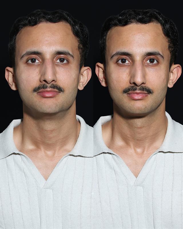 Unretouched before and after result, the drBand Clinic