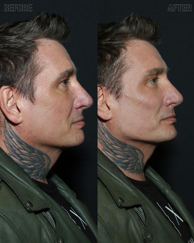 Unretouched before and after result, the drBand Clinic