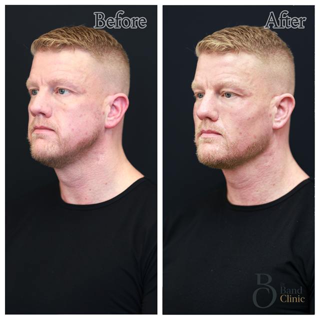 Unretouched before and after result, the drBand Clinic