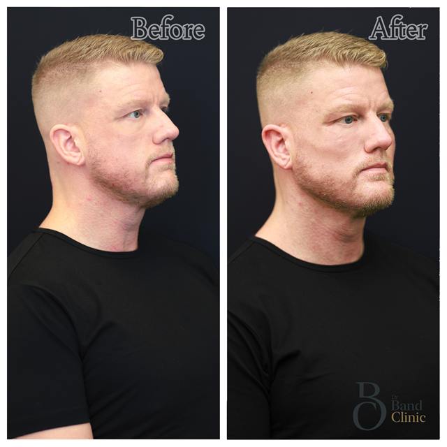 Unretouched before and after result, the drBand Clinic