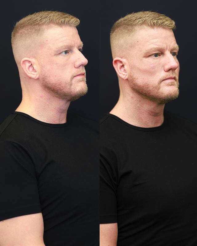 Unretouched before and after result, the drBand Clinic
