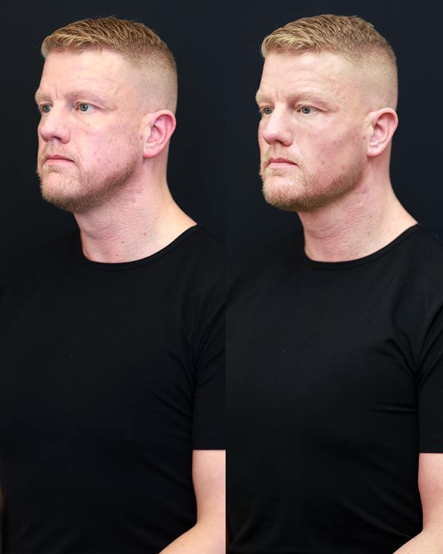 Unretouched before and after result, the drBand Clinic