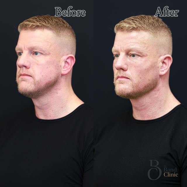 Unretouched before and after result, the drBand Clinic