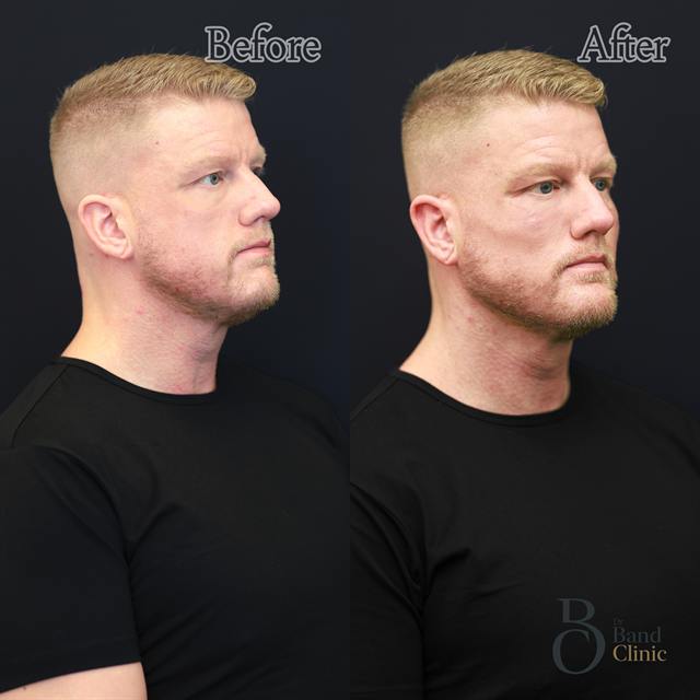Unretouched before and after result, the drBand Clinic