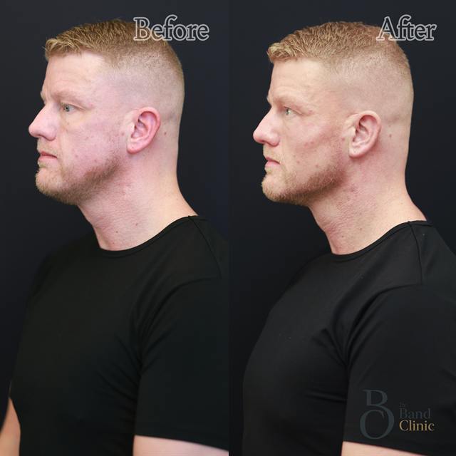 Unretouched before and after result, the drBand Clinic