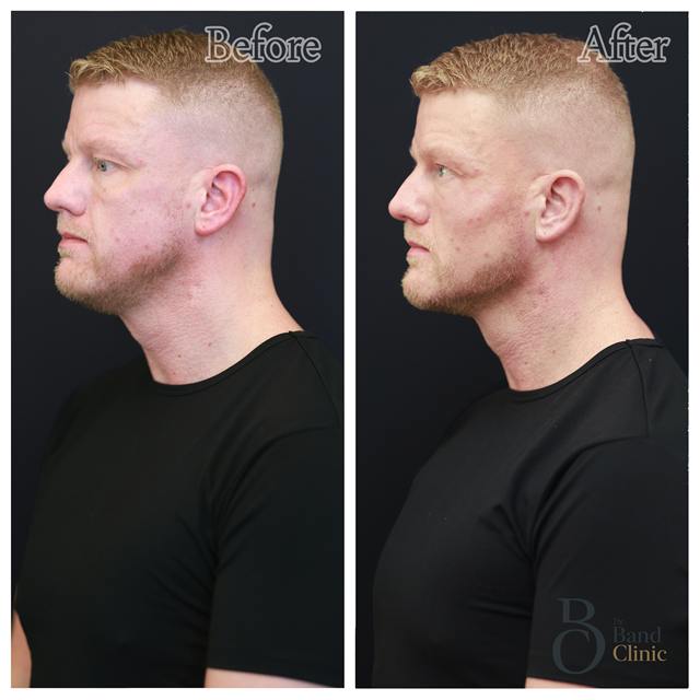 Unretouched before and after result, the drBand Clinic
