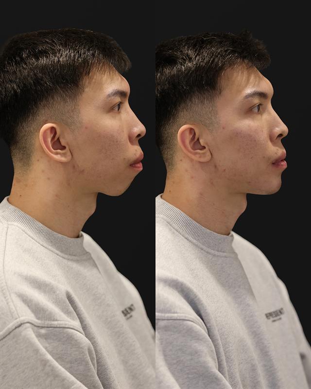Unretouched before and after result, the drBand Clinic