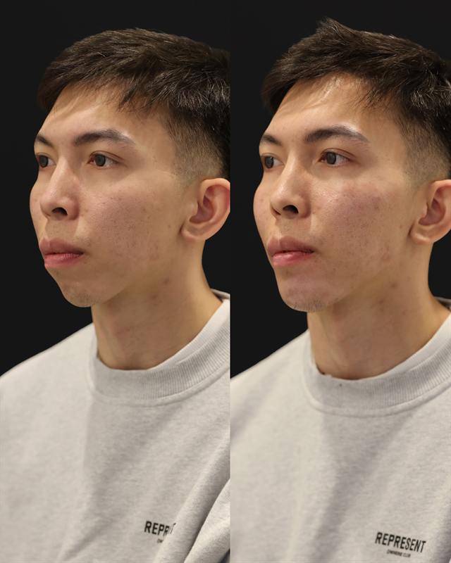 Unretouched before and after result, the drBand Clinic
