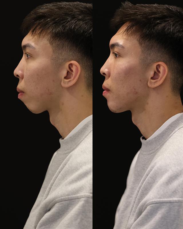 Unretouched before and after result, the drBand Clinic