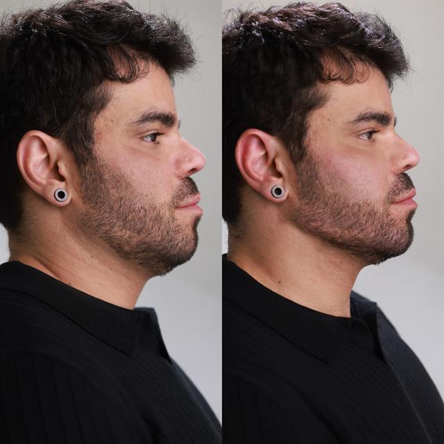 Unretouched before and after result, the drBand Clinic